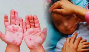Alerta en el norte del Perú por brote de virus Coxsackie: reportan más de 30 casos de la infección viral "mano, pie y boca"