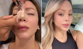 Sheyla Rojas muestra el resultado de su nueva rinoplastia tras retoque estético: "Quería que no me cambie la cara"