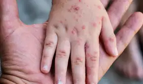 Amplían por 90 días emergencia sanitaria por brote de sarampión y riesgo de contagio en 11 regiones
