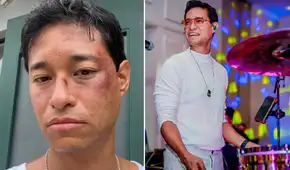 Tony Succar preocupa al aparecer con moretones y revela qué le pasó: “Pudo haber sido peor”