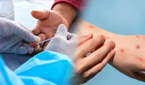 Casos de sífilis aumentan en Lima: varones de entre 20 y 34 años concentran más de la mitad de nuevos diagnósticos