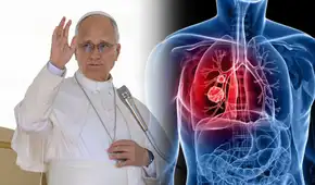 ¿El nódulo pulmonar del papa León XIV podría ser cáncer? Doctor Elmer Huerta  qué es y qué riesgo existe en operación