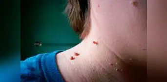 ¿Qué son y cómo quitar los lunares de carne o acrocordones? ¿Qué son y cómo quitar los lunares de carne o acrocordones?