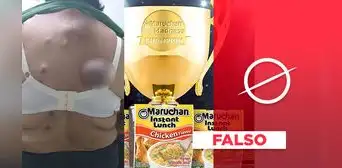 Los tumores de la foto viral no fueron causados por tomar sopa instantánea Los tumores de la foto viral no fueron causados por tomar sopa instantánea