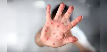 Más de 22 millones de bebés no se vacunaron contra el sarampión durante la pandemia de la Covid-19