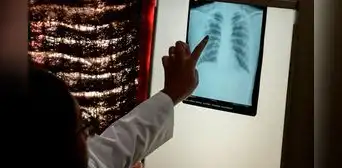 La tuberculosis vuelve a propagarse en todo el mundo, advierte la OMS La tuberculosis vuelve a propagarse en todo el mundo, advierte la OMS