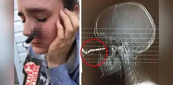 Joven se alistaba para conducir y termina con la llave del auto incrustada en su rostro Joven se alistaba para conducir y termina con la llave del auto incrustada en su rostro
