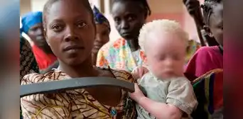 Niño albino fue hallado muerto y desmembrado en presunto ritual mágico en el Congo Niño albino fue hallado muerto y desmembrado en presunto ritual mágico en el Congo