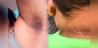 ¿Por qué me salen manchas oscuras en el cuello, axilas o entrepierna, y cómo eliminarlas?
