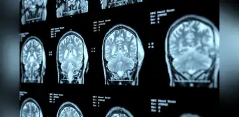 Médicos de China reportan un probable primer caso de alzheimer en paciente de 19 años Médicos de China reportan un probable primer caso de alzheimer en paciente de 19 años