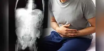 Hombre acude al hospital por dolor abdominal y encuentran tijeras quirúrgicas en su intestino
