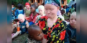 Vivir con miedo: niños y adultos albinos en África son asesinados para el tráfico de órganos Vivir con miedo: niños y adultos albinos en África son asesinados para el tráfico de órganos