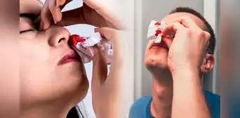 Por esta razón nunca debes inclinar tu cabeza hacia atrás cuando te sangra a nariz