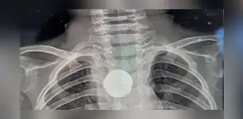 Niño de un año se traga una pila y sobrevive 5 semanas con el objeto atascado en su esófago