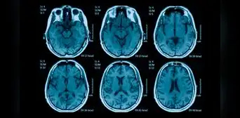 Impactante: estudio revela cuántos años envejece el cerebro tras una noche sin dormir Impactante: estudio revela cuántos años envejece el cerebro tras una noche sin dormir