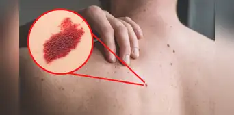 ¿Por qué algunas personas tienen lunares de sangre y qué tan peligrosos son?