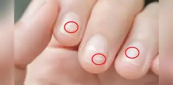 ¿Por qué aparecen manchas blancas en las uñas de los dedos y cómo eliminarlas? ¿Por qué aparecen manchas blancas en las uñas de los dedos y cómo eliminarlas?