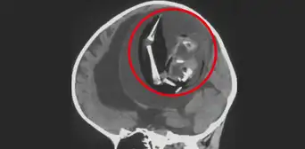 Médicos extraen un feto del cerebro de una bebé: se trata de su gemelo no nacido Médicos extraen un feto del cerebro de una bebé: se trata de su gemelo no nacido