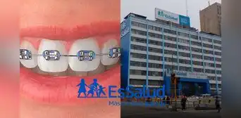 ¿Puedo ponerme brackets con el seguro de EsSalud? ¿Puedo ponerme brackets con el seguro de EsSalud?