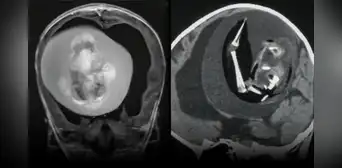 Un feto con columna vertebral y dedos fue extirpado del cerebro de una bebé de 1 año Un feto con columna vertebral y dedos fue extirpado del cerebro de una bebé de 1 año