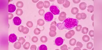 Píldora experimental consigue la remisión completa del cáncer en 18 pacientes con leucemia resistente Píldora experimental consigue la remisión completa del cáncer en 18 pacientes con leucemia resistente