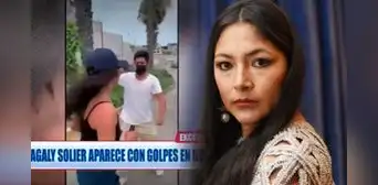 Magaly Solier preocupa a fans tras ser captada en hospital con moretón en el rostro
