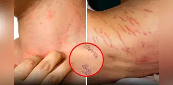 Piensa que tiene un simple sarpullido, pero en el hospital descubren gusanos debajo de su piel
