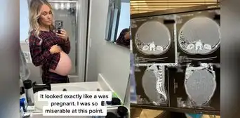 Mujer lucía como embarazada a pesar de dar a luz meses antes: tenía un quiste de 9 kilos