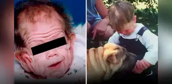 El increíble caso de Tomm Tennent, el bebé que nació con un alarmante exceso de piel El increíble caso de Tomm Tennent, el bebé que nació con un alarmante exceso de piel