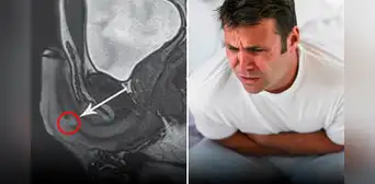 Hombre se fracturó el pene mientras practicaba la pose sexual ‘más peligrosa del mundo’ Hombre se fracturó el pene mientras practicaba la pose sexual ‘más peligrosa del mundo’