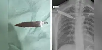 Médicos suturaron lesión a joven, pero le dejaron un cuchillo en la espalda por más de un mes