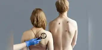Riesgo de cáncer de piel se incrementa debido a las altas temperaturas en el norte Riesgo de cáncer de piel se incrementa debido a las altas temperaturas en el norte