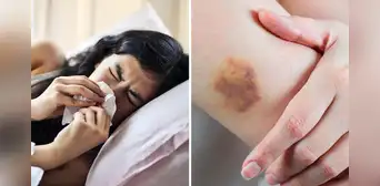 Tenía dolor de garganta, le diagnosticaron amigdalitis, pero descubre que sufre de leucemia
