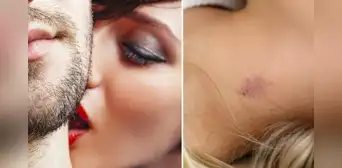¿Cómo quitar los chupetones sin usar maquillaje de manera efectiva?