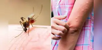 ¿Es cierto que los mosquitos pican más a las personas con sangre 'dulce'?: la verdad detrás del mito