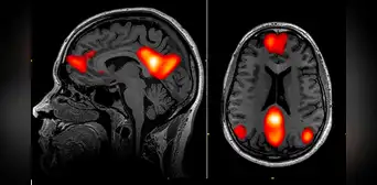 Inteligencia artificial puede detectar el Parkinson años antes de que aparezcan los síntomas Inteligencia artificial puede detectar el Parkinson años antes de que aparezcan los síntomas