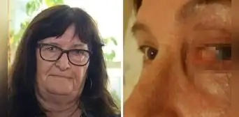 Domi, la mujer que pasó más de 50 años con una piedra en el ojo y nadie le creyó