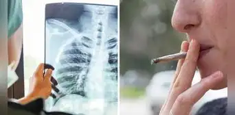 Mujer es diagnosticada de cáncer de pulmón terminal a pesar de que nunca fumó: ¿a qué se debe?