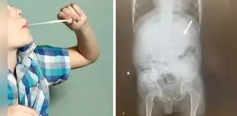 Niño tuvo que ser operado en EE. UU. tras tragarse 40 chicles y obstruir su sistema digestivo Niño tuvo que ser operado en EE. UU. tras tragarse 40 chicles y obstruir su sistema digestivo