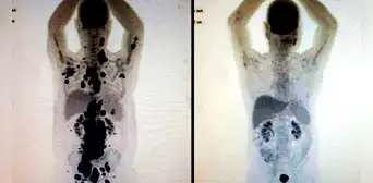 El antes y después de un paciente con cáncer que recibió prometedora terapia de células