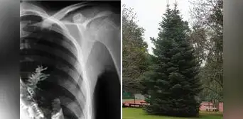 Fue al hospital por dolor de pecho y médicos hallaron parte de un árbol creciendo en su pulmón Fue al hospital por dolor de pecho y médicos hallaron parte de un árbol creciendo en su pulmón