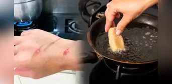 ¿Las quemaduras con aceite dejan cicatrices? Conoce cómo tratar estas heridas