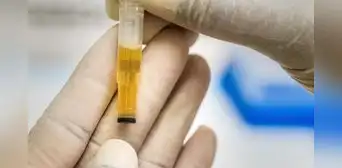 ¿Qué significa el color de la orina y en qué casos representa una infección?