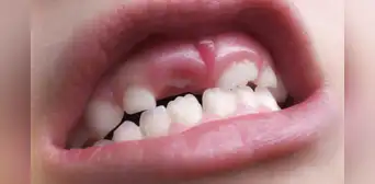 Así funciona el fármaco experimental que podría regenerar los dientes caídos