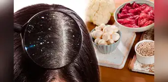 ¡Olvídate de la caspa! Descubre quévitamina necesitas consumir para eliminarla para siempre ¡Olvídate de la caspa! Descubre quévitamina necesitas consumir para eliminarla para siempre