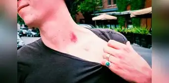 La historia del joven que murió luego de que su novia le causó un chupetón La historia del joven que murió luego de que su novia le causó un chupetón