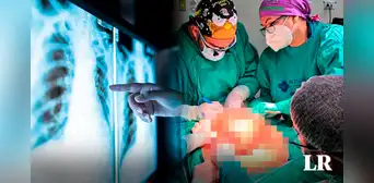 Equipo de más de 20 médicos extirpa un tumor de 4,2 kilos en operación de 11 horas en Chile Equipo de más de 20 médicos extirpa un tumor de 4,2 kilos en operación de 11 horas en Chile