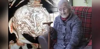 Estela Meléndez, la anciana que tuvo por más de 60 años un feto momificado dentro de su cuerpo Estela Meléndez, la anciana que tuvo por más de 60 años un feto momificado dentro de su cuerpo