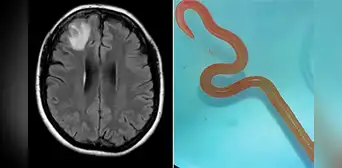 Médicos hallan un gusano vivo de 8 cm en el cerebro de una mujer en Australia Médicos hallan un gusano vivo de 8 cm en el cerebro de una mujer en Australia