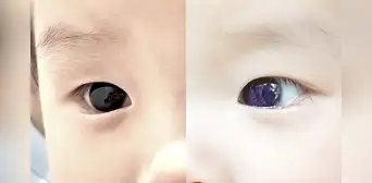 Color de ojos de bebé cambia tras recibir presunto fármaco contra la COVID-19 Color de ojos de bebé cambia tras recibir presunto fármaco contra la COVID-19